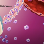 <b>Orencia</b><br>Rheumatoid Arthritis